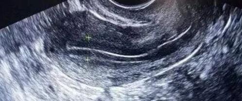 吃二甲双瓜可以做b超吗,安全兼顾的健康探索